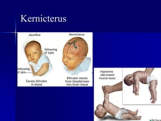 Kernicterus
 