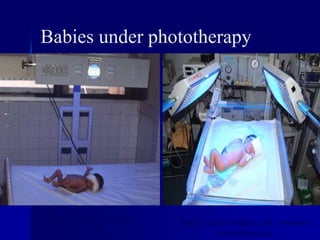 Babies under phototherapy
Baby under conventional
phototherapy
Baby under triple unit intense
phototherapy
 