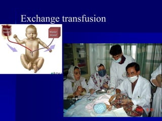 Exchange transfusion
 