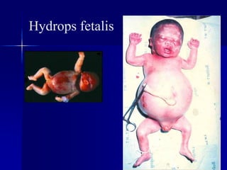 Hydrops fetalis
 