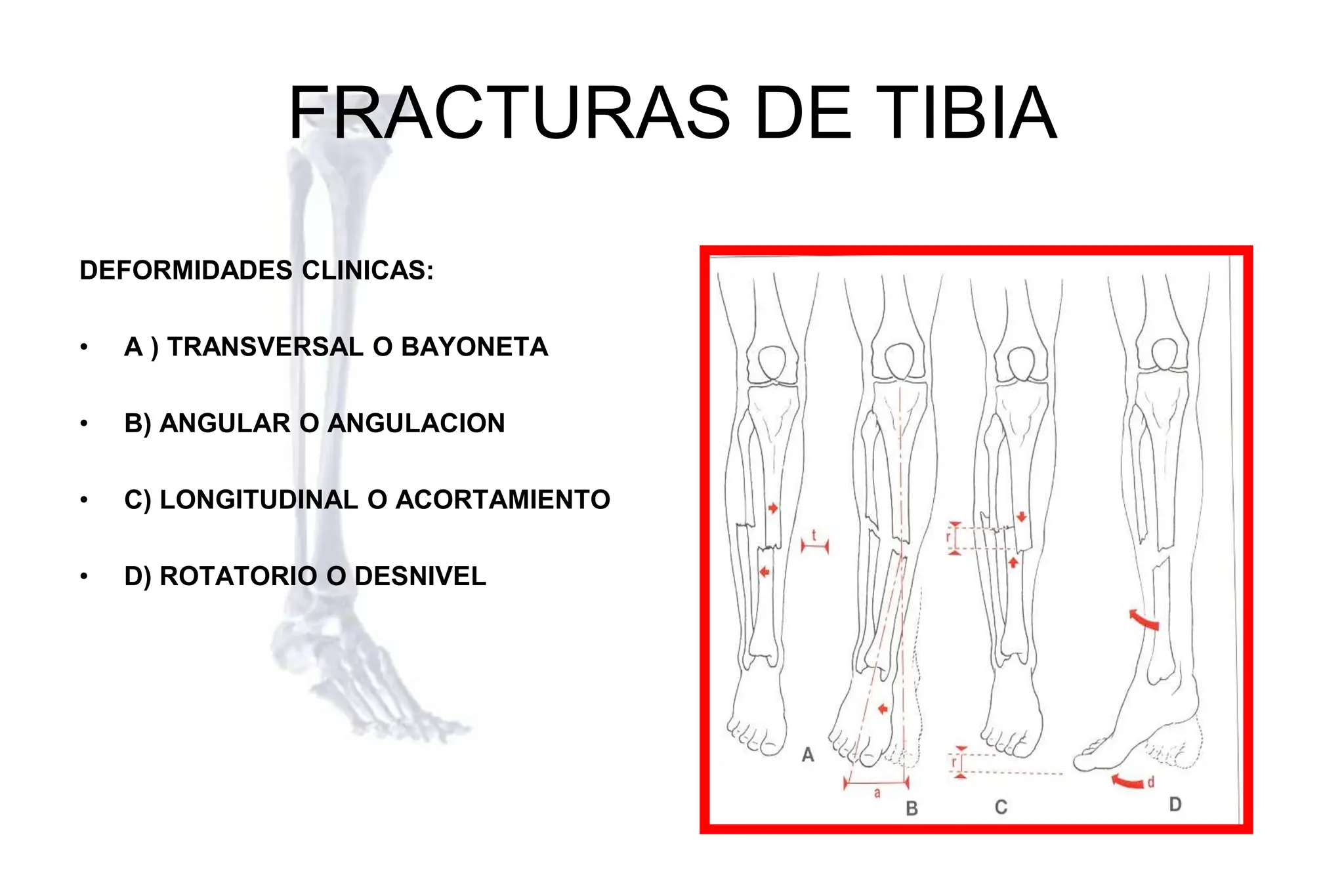 34 FRACTURAS DE TIBIA esm ipn.ppsx