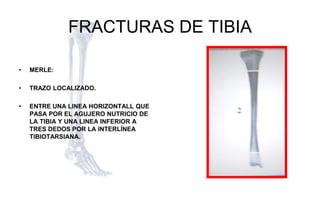 Tibia Linea 34 FRACTURAS DE TIBIA esm ipn.ppsx