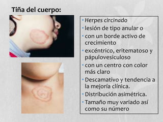 Tiña del cuerpo:
• Herpes circinado
• lesión de tipo anular o
• con un borde activo de
crecimiento
• excéntrico, eritematoso y
pápulovesiculoso
• con un centro con color
más claro
• Descamativo y tendencia a
la mejoría clínica.
• Distribución asimétrica.
• Tamaño muy variado así
como su número

 