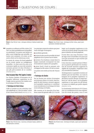 36
EN
FORMATION
jj> QUESTIONS DE COURS
PratiqueVet (2011) 46 : 158-161 (160)
paupière en utilisant un ﬁl ﬁn (nylon 5/0)
chez un chien préalablement tranquillisé
ou anesthésié. Ces points sont laissés en
place aussi longtemps que possible, au
moins trois semaines si la mère ou les
autres chiots ne les retirent pas avant.
Le retrait de contact du bord palpébral
sur la cornée amène un soulagement
immédiat : le chiot ouvre les yeux et la
croissance rapide au cours des semaines
suivantes permet à la face d’évoluer et
aux plis péri-oculaires de se combler.
(PHOTOS 3 ET 4).
Chez le jeune Shar-Peï (après 2 mois)
Les formes limitées d’entropion de la
paupière inférieure, supérieure ou de
l’angle externe peuvent être traitées avec
la technique de Hotz-Celsus.
> Technique de Hotz-Celsus
Celle-ci consiste en une résection cuta-
née palpébrale en “côte de melon” suivie
d’une suture bord à bord (PHOTOS 5 ET 6).
Les principes restent les mêmes que pour
toute chirurgie d’entropion :
■ anesthésie générale ;
■ incision la plus proche possible du bord
palpébral tout en préservant le limbe ;
■ excision d’un lambeau cutané dont la
largeur maximale correspond à la zone
d’enroulement majeur de la paupière ;
■ suture bord à bord en prenant soin
d’éloigner les ﬁls (nylon 5/0) de la cornée.
Les points sont retirés au bout de 10 jours
[6].
> Technique de Stades
Sur les formes très sévères d’entropion
sur de jeunes chiens (4-6 mois), dans les-
quels les plis frontaux viennent appuyer
sur la paupière supérieure et contribuer
à son enroulement, la technique de choix
est la technique de Stades.
Elle consiste en la résection d’un lam-
beau cutané de grande taille (2,5-3 cm de
large) sur la paupière supérieure et à la
suture de la partie distale (frontale) de la
peau à distance du bord palpébral.
Il reste donc une zone d’environ 5 mm
de large entre le bord libre et la peau qui
n’est pas recouverte et qui cicatrise par
deuxième intention.
Cette résection cutanée permet d’élimi-
ner en partie le pli frontal et la cicatrisa-
tion de seconde intention augmente la
rigidité de la paupière, empêchant ainsi
son enroulement ultérieur.
Techniquement, la première incision est
réalisée près du bord libre, sur toute la
longueur de la paupière supérieure. La
deuxième incision dessine un large lam-
beau (en “œil de clown”) sur la paupière
supérieure et une partie du pli frontal.
La suture est réalisée par points séparés
(PHOTOS 7 ET 8).
La cicatrisation intervient en 10-12 jours,
avec un comblement de la zone exposée.
Lors du retrait des points, ceux-ci sont
Photo 5. Shar-Peï de 5 mois : entropion inférieur et latéral modéré (œil
droit).
Photo 7. Shar-Peï de 6 mois : mucinose, entropion majeur, œdème et
vascularisation cornéens.
Photo 6. Shar-Peï de 5 mois : technique de Hotz-Celsus, aspect post-
opératoire immédiat (œil droit).
Photo 8. Shar-Peï de 6 mois : technique de Stades, aspect post-opératoire
immédiat.
 