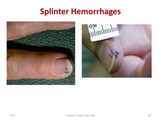 Rheumatic fever, RHD, and infective endocarditis | PPTX