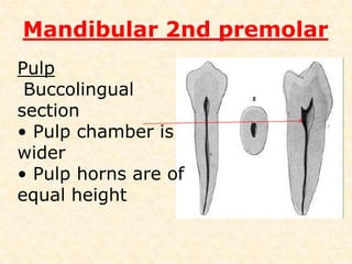 Mandibular 2nd premolar2 lingual cusps (most commonly) • Mesiolingual – major,      2/3 MD diameter,       same height as Buccal • Distolingual – minorLingual groove2/3