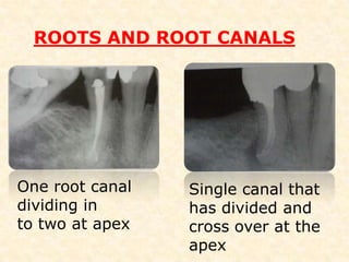 Mandibular 2nd premolarPULP CHAMBER  Mesiodistal width    -  narrow 