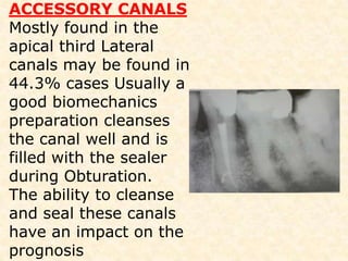   Lingual horn is more prominent      under a well developed lingual            cusp  30 lingual tilt