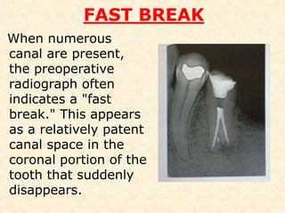 Mandibular 2nd premolarROOTS AND ROOT CANALS1 Canal 1 foramen  -  85.5 %1 canal 2 foramen   -  11.5 %2 Canal 1 foramen   -  1.5 %3 canal                   -  0.5 %Distal curve          – 40 %Straight               – 39 %Buccal curve         – 11 %Lingual curve        – 10 %