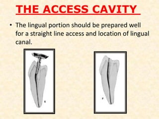 Anatomic relationships in situAvoid over instrumentation and overfill When viewing an x-ray of this area, the mental foramen is sometimes misdiagnosed as a premolar abscess. Therefore, before performing root canal therapy, make sure all diagnostic tests confirm your finding.