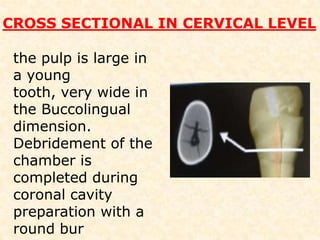 FAST BREAK  When numerous canalare present, the preoperative radiograph often indicates a "fast break." This appears as a relatively patent canal space in the coronal portion of the tooth that suddenly disappears.