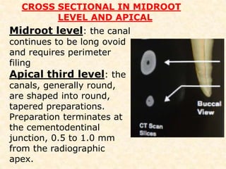 FAST BREAKNote: If a straight-on preoperative radiograph of a Mandibular 2 premolar shows the pulp canal disappearing in mid-root, this is an important indication that two canals are present.
