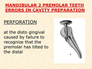 Mandibular 2nd premolarThe mandibular second premolar is similar to the first premolar, with the following differences:  The lingual pulp horn usually is      larger  The root and root canal are more                         often oval than round  The pulp chamber is wider       buccolingually