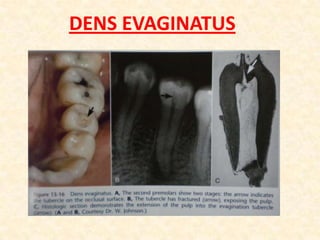 MANDIBULAR 2 PREMOLAR TEETHERRORS IN CAVITY PREPARATIONAPICAL PERFORATIONOf an invitingly straightconical canal. Failure to establish the exact length of the tooth leads to trephination of the foramen