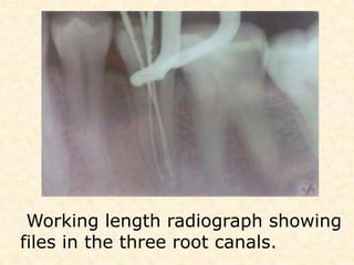 They include nonsurgical endodontic treatment, endodontic surgery and  extraction. 