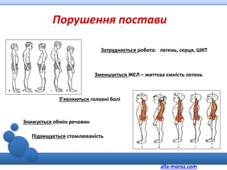 Знижується обмін речовин
Підвищується стомлюваність
З’являються головні болі
Зменшується ЖЄЛ – життєва ємність легень
Затрудняється робота: легень, серця, ШКТ
Порушення постави
alla-moroz.com
 
