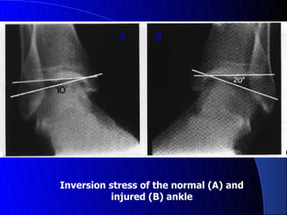 Normal Inversion Range Ankle sport injuries.pdf