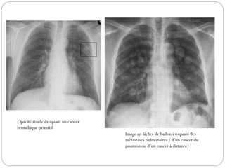Opacité ronde évoquant un cancer
bronchique primitif
Image en lâcher de ballon évoquant des
métastases pulmonaires ( d’un cancer du
poumon ou d’un cancer à distance)
 