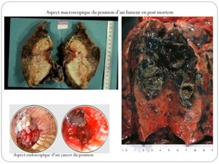 Aspect endoscopique d’un cancer du poumon
Aspect macroscopique du poumon d’un fumeur en post mortem
 