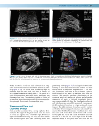 Fetal Cardiovascular Imaging A Disease Based Approach 1st Jack Rychik | PDF
