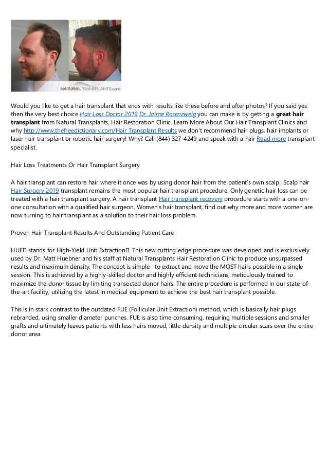 Great Photos Of Hair Transplants Before And After Hair Transplant Res