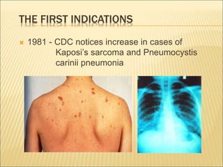 THE FIRST INDICATIONS
 1981 - CDC notices increase in cases of
Kaposi’s sarcoma and Pneumocystis
carinii pneumonia
 