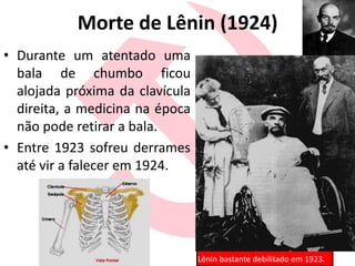 Morte de Lênin (1924)
• Durante um atentado uma
bala de chumbo ficou
alojada próxima da clavícula
direita, a medicina na época
não pode retirar a bala.
• Entre 1923 sofreu derrames
até vir a falecer em 1924.
Lênin bastante debilitado em 1923.
 