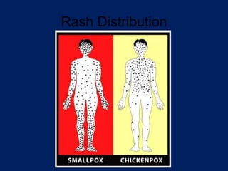 German-Measles 355588092-German-Measles.ppt