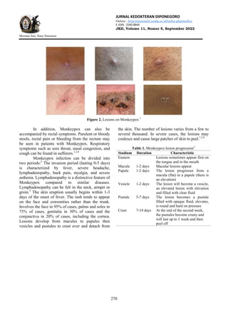 JURNAL KEDOKTERAN DIPONEGORO
Online : http://ejournal3.undip.ac.id/index.php/medico
E-ISSN : 2540-8844
JKD, Volume 11, Nomor 5, September 2022
Meiriani Sari, Nany Hairunisa
270
Figure 2. Lesions on Monkeypox 1
In addition, Monkeypox can also be
accompanied by rectal symptoms. Purulent or bloody
stools, rectal pain or bleeding from the rectum may
be seen in patients with Monkeypox. Respiratory
symptoms such as sore throat, nasal congestion, and
cough can be found in sufferers.1,2,8
Monkeypox infection can be divided into
two periods:2
The invasion period (lasting 0-5 days)
is characterized by fever, severe headache,
lymphadenopathy, back pain, myalgia, and severe
asthenia. Lymphadenopathy is a distinctive feature of
Monkeypox compared to similar diseases.
Lymphadenopathy can be felt in the neck, armpit or
groin.2
The skin eruption usually begins within 1-3
days of the onset of fever. The rash tends to appear
on the face and extremities rather than the trunk.
Involves the face in 95% of cases, palms and soles in
75% of cases, genitalia in 30% of cases and the
conjunctiva in 20% of cases, including the cornea.
Lesions develop from macules to papules then
vesicles and pustules to crust over and detach from
the skin. The number of lesions varies from a few to
several thousand. In severe cases, the lesions may
coalesce and cause large patches of skin to peel.1,2,8
Table 1. Monkeypox lesion progression2
Stadium Duration Characteristic
Enatem Lesions sometimes appear first on
the tongue and in the mouth
Macula 1-2 days Macular lesions appear
Papule 1-2 days The lesion progresses from a
macula (flat) to a papule (there is
an elevation)
Vesicle 1-2 days The lesion will become a vesicle,
an elevated lesion with elevation
and filled with clear fluid
Pustule 5-7 days The lesion becomes a pustule
filled with opaque fluid, elevates,
is round and hard on pressure
Crust 7-14 days At the end of the second week,
the pustules become crusty and
will last up to 1 week and then
peel off
 