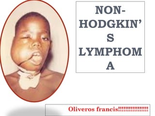 NON-
HODGKIN’
S
LYMPHOM
A
Oliveros francis!!!!!!!!!!!!!!!!!
 