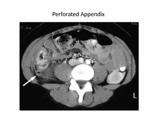 Complications-of-Appendicitis. when things go wrong | PPTX