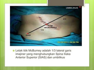  Letak titik McBurney adalah 1/3 lateral garis
imajiner yang menghubungkan Spina Iliaka
Anterior Superior (SIAS) dan umbilikus
 