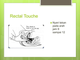 Rectal Touche
 Nyeri tekan
pada arah
jam 9
sampai 12
 