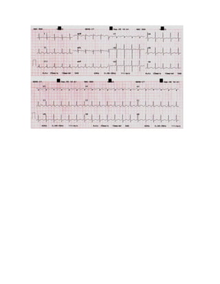 35 electrocardiogramas parte 2
