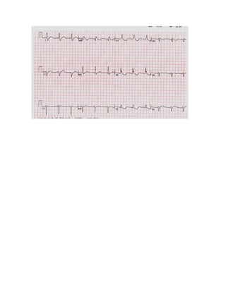 35 electrocardiogramas parte 2