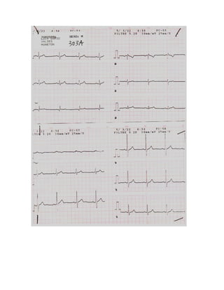 35 electrocardiogramas parte 2