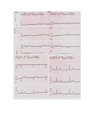 35 electrocardiogramas parte 2
