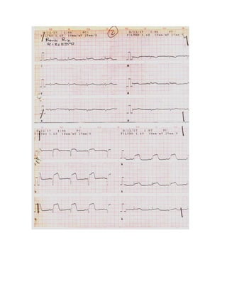 35 electrocardiogramas parte 2