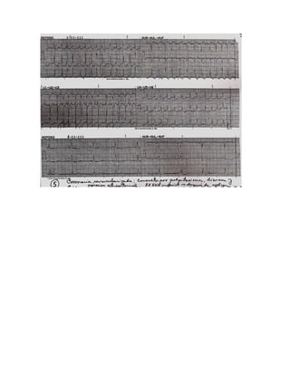 35 electrocardiogramas parte 2