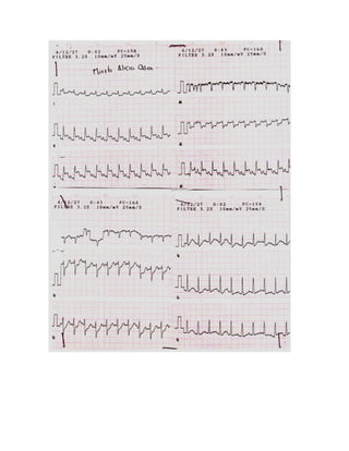 35 electrocardiogramas parte 2