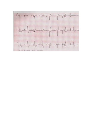 35 electrocardiogramas parte 2