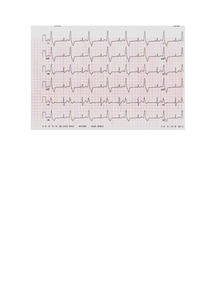 35 electrocardiogramas parte 2