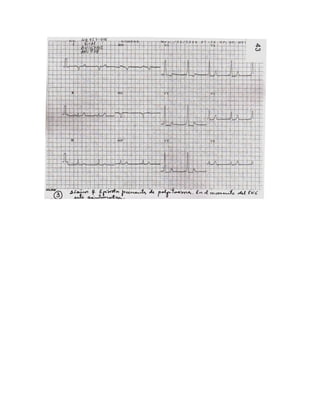 35 electrocardiogramas parte 2