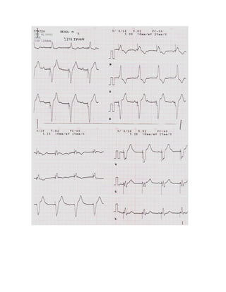 35 electrocardiogramas parte 2