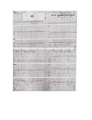 35 electrocardiogramas parte 2