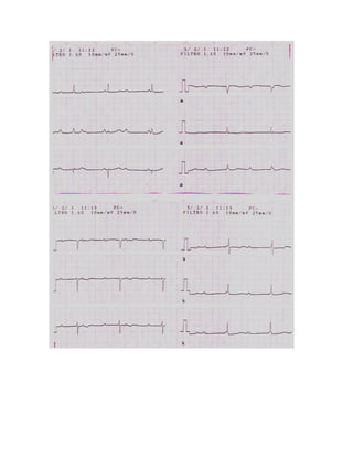 35 electrocardiogramas parte 2