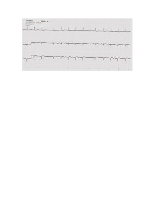 35 electrocardiogramas parte 2