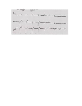 35 electrocardiogramas parte 2