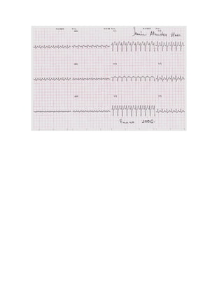 35 electrocardiogramas parte 2