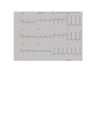 35 electrocardiogramas parte 2